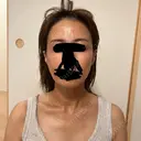 脂肪注入（額） Mods Clinic（モッズクリニック） 福岡院 DAY 113 サムネイル用