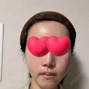 脂肪注入（輪郭） / PRP皮膚再生療法 EMMO FACE CLINIC 大宮院 DAY 2 サムネイル用