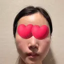 脂肪注入（輪郭） / PRP皮膚再生療法 EMMO FACE CLINIC 大宮院 DAY 3 サムネイル用