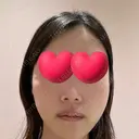 脂肪注入（輪郭） / PRP皮膚再生療法 EMMO FACE CLINIC 大宮院 DAY 4 サムネイル用
