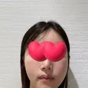 脂肪注入（輪郭） / PRP皮膚再生療法 EMMO FACE CLINIC 大宮院 DAY 7 サムネイル用