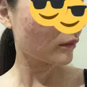 肌ヒアルロン酸注入（たるみ・シワ改善） / ヒアルロン酸注入（首） シェリークリニック 新宿本院 DAY 0 サムネイル用