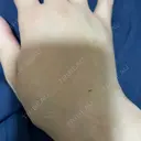 脂肪注入（肌） EMMO FACE CLINIC 大阪梅田院 DAY 10 サムネイル用