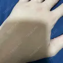 脂肪注入（肌） EMMO FACE CLINIC 大阪梅田院 DAY 10 サムネイル用