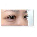 ヒアルロン酸注入（涙袋） NARU Beauty Clinic 【ナルクリ】 DAY 4 サムネイル用