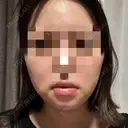 骨切り（あご） / 脂肪吸引（顔） アーククリニック DAY 7 サムネイル用