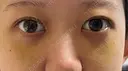 下まぶたの脂肪取り APOLLO BEAUTY CLINIC DAY 8 サムネイル用