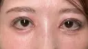 二重埋没 / 目頭切開 / クマ治療 ROOTS Clinic DAY 12 サムネイル用