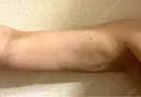 脂肪吸引（二の腕） / 脂肪吸引（肩） 東京脂肪吸引クリニック DAY 61 サムネイル用