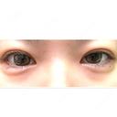 ヒアルロン酸注入（涙袋） NARU Beauty Clinic 【ナルクリ】 DAY 5 サムネイル用