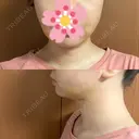 糸リフト / 脂肪吸引（顔） EMMA CLINIC（エマクリニック） DAY 10 サムネイル用