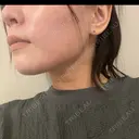 ボトックス（エラ・小顔） BiBiクリニック AFTER サムネイル用