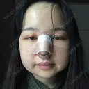 隆鼻術 / 鼻尖形成（切開） / 軟骨移植 / ワシ鼻修正・ハンプ切除 / 鼻尖縮小 表参道スキンクリニック 表参道院 DAY 4 サムネイル用