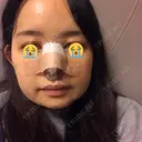 隆鼻術 / 鼻尖形成（切開） / 軟骨移植 / ワシ鼻修正・ハンプ切除 / 鼻尖縮小 表参道スキンクリニック 表参道院 DAY 5 サムネイル用