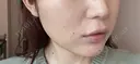 ボトックス（あご） / ヒアルロン酸注入（あご） / ボトックス（エラ・小顔） / ヒアルロン酸注入（唇） THE FIRST CLINIC 町田院 DAY 0 サムネイル用