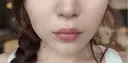 ボトックス（あご） / ヒアルロン酸注入（あご） / ボトックス（エラ・小顔） / ヒアルロン酸注入（唇） THE FIRST CLINIC 町田院 AFTER サムネイル用
