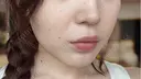 ボトックス（あご） / ヒアルロン酸注入（あご） / ボトックス（エラ・小顔） / ヒアルロン酸注入（唇） THE FIRST CLINIC 町田院 DAY 3 サムネイル用