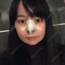 隆鼻術 / 鼻尖形成（切開） / 軟骨移植 / ワシ鼻修正・ハンプ切除 / 鼻尖縮小 表参道スキンクリニック 表参道院 DAY 7 サムネイル用