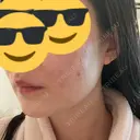 肌ヒアルロン酸注入（たるみ・シワ改善） / ヒアルロン酸注入（首） シェリークリニック 新宿本院 DAY 7 サムネイル用