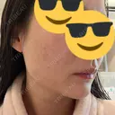 肌ヒアルロン酸注入（たるみ・シワ改善） / ヒアルロン酸注入（首） シェリークリニック 新宿本院 DAY 7 サムネイル用