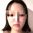 骨切り（あご） / 脂肪吸引（顔） アーククリニック DAY 9 サムネイル用