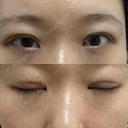 二重埋没 / その他（目元） / クマ治療 / ボトックス（エラ・小顔） / ヒアルロン酸注入（額） / ボトックス（肩） TCB東京中央美容外科 京都四条院 DAY 15 サムネイル用