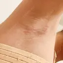 豊胸（シリコンバッグ） / 胸修正 NANA（ナナ）美容外科 DAY 13 サムネイル用