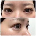 ヒアルロン酸注入（涙袋） NARU Beauty Clinic 【ナルクリ】 DAY 7 サムネイル用