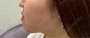 糸リフト / 脂肪吸引（顔） / ヒアルロン酸注入（あご） / ボトックス（エラ・小顔） R Beauty CLINIC 名古屋院 DAY 104 サムネイル用