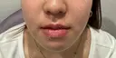 糸リフト / 脂肪吸引（顔） / ヒアルロン酸注入（あご） / ボトックス（エラ・小顔） R Beauty CLINIC 名古屋院 AFTER サムネイル用