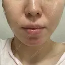 糸リフト / 脂肪吸引（顔） EMMA CLINIC（エマクリニック） DAY 14 サムネイル用
