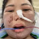 骨切り（あご） / 骨削り（エラ） / 骨削り（頬） / ルフォー+ssro（両あご) / 輪郭修正 / その他 リラ・クラニオフェイシャル・クリニック DAY 1 サムネイル用