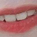 ホワイトニング LEAGRANT CLINIC 中目黒 AFTER サムネイル用