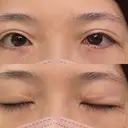 目尻切開 / タレ目形成・グラマラスライン（切開） 銀座高須クリニック DAY 372 サムネイル用