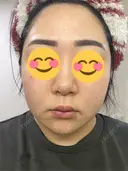 ピコレーザートーニング（美白・肝斑） / ピコフラクショナルレーザー（毛穴・ニキビ跡） おおかみ美容のクリニック 新宿院 AFTER サムネイル用