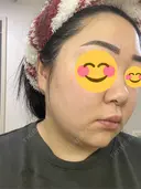 ピコレーザートーニング（美白・肝斑） / ピコフラクショナルレーザー（毛穴・ニキビ跡） おおかみ美容のクリニック 新宿院 DAY 14 サムネイル用