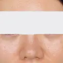 クマ治療 / ヒアルロン酸注入（目の下） ROOTS Clinic DAY 0 サムネイル用