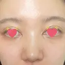 骨切幅寄せ 9BeautyClinic DAY 14 サムネイル用