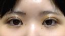 二重埋没 / 目頭切開 東京シンデレラ美容外科 池袋院 DAY 5 サムネイル用