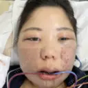 骨切り（あご） / 骨削り（エラ） / 骨削り（頬） / ルフォー+ssro（両あご) / 輪郭修正 / その他 リラ・クラニオフェイシャル・クリニック DAY 1 サムネイル用