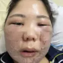 骨切り（あご） / 骨削り（エラ） / 骨削り（頬） / ルフォー+ssro（両あご) / 輪郭修正 / その他 リラ・クラニオフェイシャル・クリニック AFTER サムネイル用