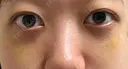 下まぶたの脂肪取り APOLLO BEAUTY CLINIC DAY 11 サムネイル用