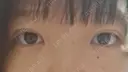 二重埋没 ルラ美容クリニック 渋谷本院 DAY 11 サムネイル用