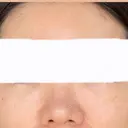 クマ治療 / ヒアルロン酸注入（目の下） ROOTS Clinic DAY 1 サムネイル用