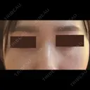 クマ治療 / 下まぶたたるみ取り / 下まぶたの脂肪取り APOLLO BEAUTY CLINIC DAY 16 サムネイル用
