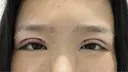 二重切開 / クマ治療 R Beauty CLINIC 銀座院 AFTER サムネイル用