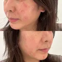 シミ取りレーザー G MEDICAL ART クリニック 新宿院 AFTER サムネイル用