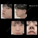 隆鼻術 / 鼻尖形成（切開） / 鼻中隔延長（切開） / 骨切幅寄せ / ワシ鼻修正・ハンプ切除 LUHO（ルホ）美容外科 DAY 90 サムネイル用