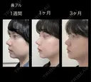 隆鼻術 / 鼻尖形成（切開） / 鼻中隔延長（切開） / 骨切幅寄せ / ワシ鼻修正・ハンプ切除 LUHO（ルホ）美容外科 DAY 90 サムネイル用
