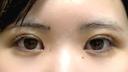 二重埋没 / 目頭切開 東京シンデレラ美容外科 池袋院 DAY 7 サムネイル用